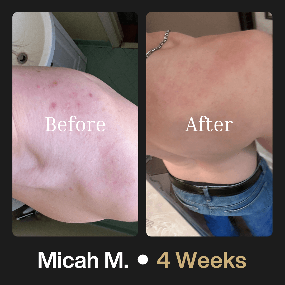 Shield System Body Acne Wash