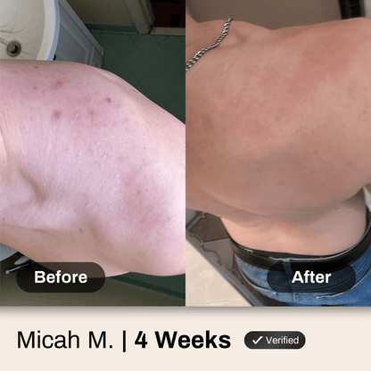 Shield System Body Acne Wash