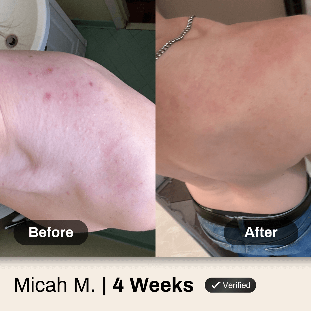 Shield System Body Acne Wash