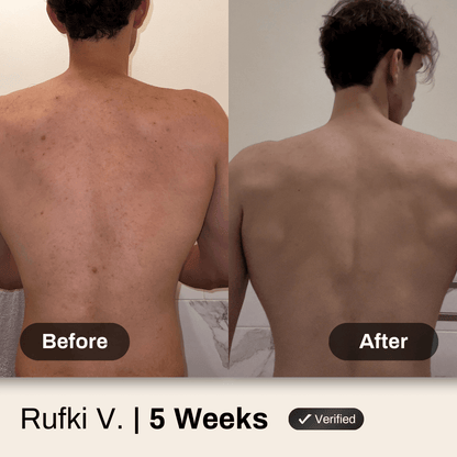 Shield System Body Acne Wash