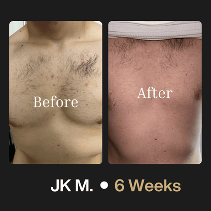 Body Acne System