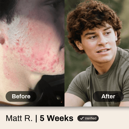 Face Acne Wash