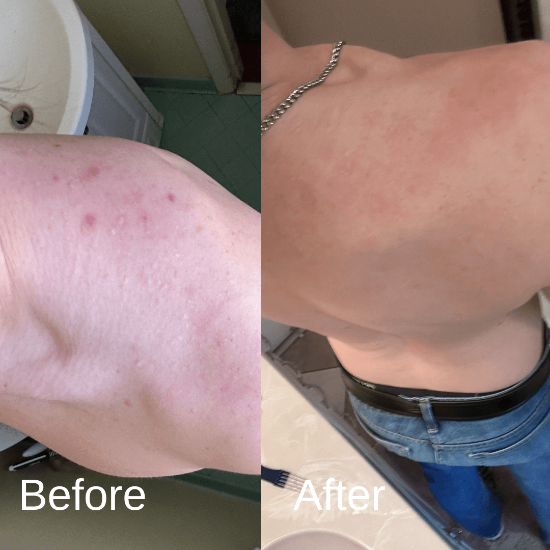 Shield System Body Acne Wash